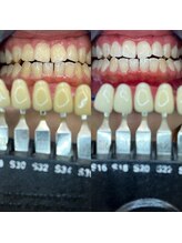 トウキョウスワーズ 池袋店(TOKYO SWRS)/#ホワイトニング #池袋 #渋谷