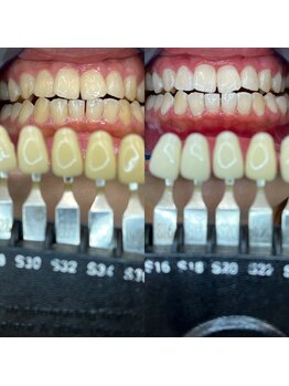トウキョウスワーズ 池袋店(TOKYO SWRS)/#ホワイトニング #池袋 #渋谷