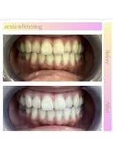 エクシアホワイトニング 沖縄宮里店/お客様ビフォア