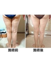 椎名亮 整体院/メディセルの施術例・セル取り