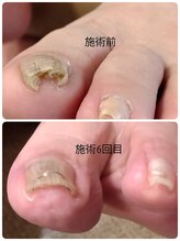 フットケアサロン ラビフット(Rabbi foot)/ネイルケア＋巻き爪ケア