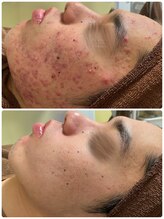 ビオエル 横浜店(Bioel)/ハーブピーリング/横浜