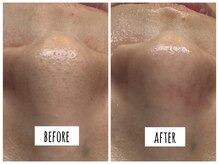 ハオン(HAON)/毛穴洗浄×ハーブピーリング