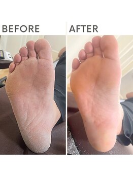 クオッカ(Quokka)/ガサガサかかとの角質除去