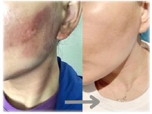 メディカルフェイシャルエステティック サロン ド ヴェリテ(VERITE)/炭酸パック