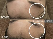 サロンワイアネシス(Salon y ANESIS)/ハーブピーリング１回の変化