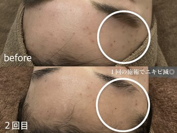 サロンワイアネシス(Salon y ANESIS)/ハーブピーリング１回の変化