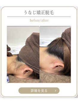 ミース 上野店/うなじ脱毛で清潔感UP