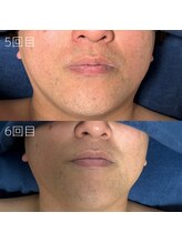 カナウ(KANAU)/ヒゲ脱毛（40代前半男性）