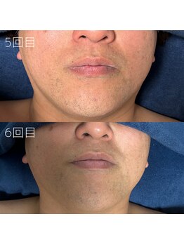 カナウ(KANAU)/ヒゲ脱毛（40代前半男性）