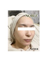 ノーブル 新宿南口(NOBLE)/新宿ハーブピーリングNOBLE