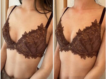 美バストアルファ(美bust α)/【バストアップ】症例