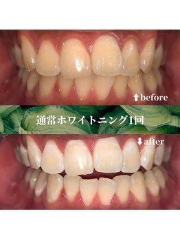 フタバ 天神大名店(futaba)/初回ホワイトニングbefore after