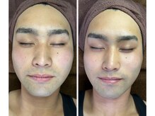 オリ(Oli)/冬が勝負脱毛、フェイシャル