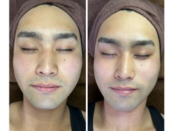 オリ(Oli)/冬が勝負脱毛、フェイシャル