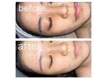 ラクシー 北千住(luxssy)/顔シェービング