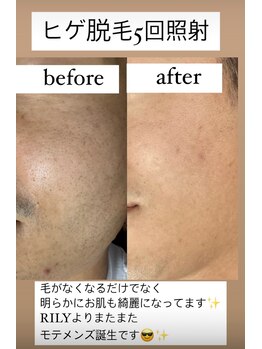 リリー(RILY)/【ビフォーアフター】