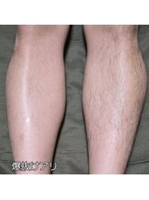 エステティック らぽーる(Rapport)/ムダ毛のない爽快な毎日を♪