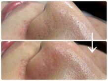 ニコ(Nico)/毛穴エクストラクション