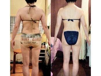 リッチ(Riche)/キャビラジ痩身ビフォーアフター