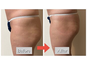 オレンジ(Orange)/2部位/痩身マシンBefore After