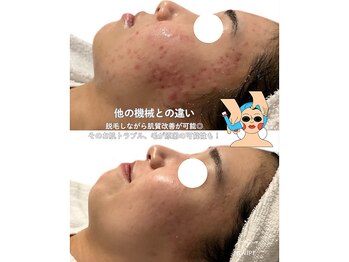 サラ 恵比寿店(SARA)/３フォトRF ニキビケア