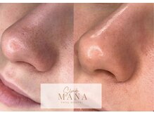 サロンドマナ(salon de MANA)の雰囲気(専用オイルパックで汚れを浮かせ肌負担なく毛穴洗浄)