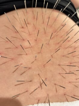 ハリドコロケン(KEN)/腰部は月経の不調も関係します