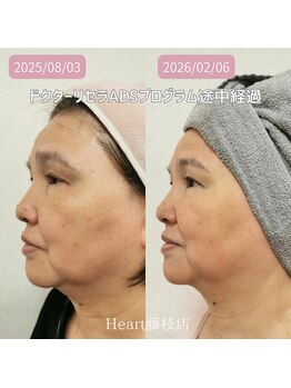 ハート 藤枝店(Heart)/ドクターリセラADSプログラム