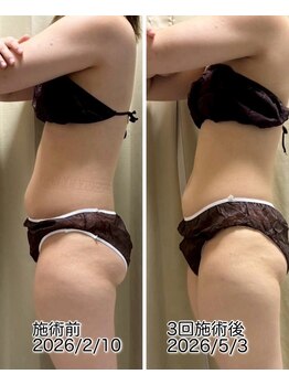 クールスパ(COOL SPA)/20代女性お腹症例
