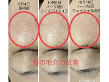 エメ 心斎橋(Aimer)/毛穴グリーンハーブピーリング