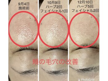 エメ 心斎橋(Aimer)/毛穴グリーンハーブピーリング