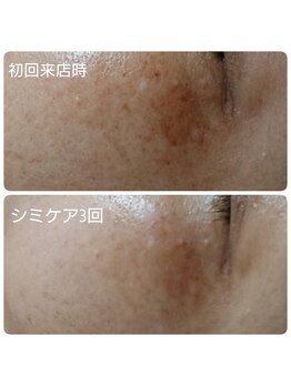 ロコモ 美容矯正サロン(Locomo)/シミケア3回でくすみ改善中