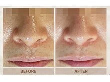 ベニバナ 五反田駅前/エクソソームスピキュールピール