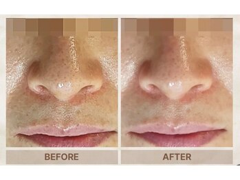 ベニバナ 五反田駅前/エクソソームスピキュールピール