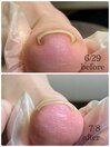 巻爪ケア