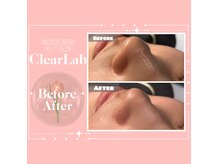 クリアラボ 日本橋(Clear Lab)の雰囲気（フォトギャラに韓国式毛穴洗浄のBefore⇒After多数掲載中◎）