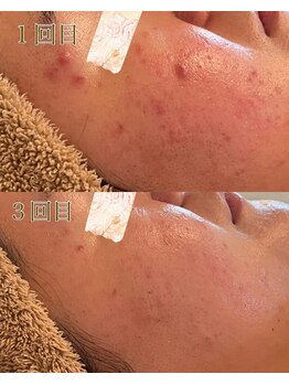 シェリモ(Cherimo)/繰り返す肌悩み撃退！