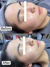 リル(Rire)/Before→After　20代