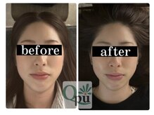 キュープ 下関店(Qpu)/通常コース4回での変化