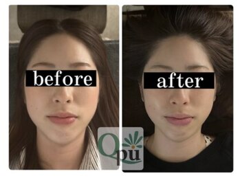 キュープ 下関店(Qpu)/通常コース4回での変化