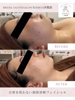 リバース(Rebirth)/脂肪燃焼小顔コース
