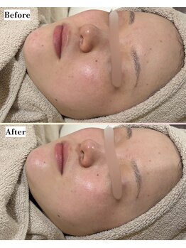 ソワナ(soina)/【神楽坂駅/フェイシャル/毛穴】