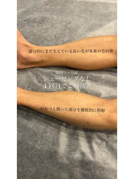 ブラックベルベット 24(BLACK VELVET 24)/夏に向けた【足脱毛】