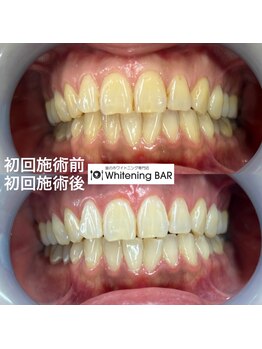 ホワイトニングバー 金沢フォーラス店/初回ビフォーアフターをご紹介
