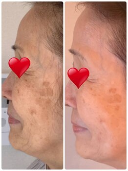 クラッシー 本八幡(CLASSY+)/1ヵ月スキンケアモニター