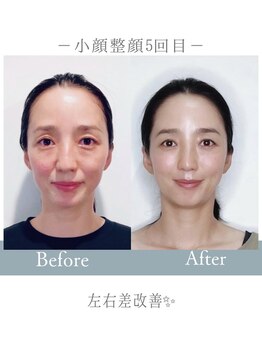 オリノ(Olino)/小顔もリフトも両方叶う！