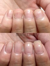 マリーロール 淀屋橋本店(Marie Laure)/自爪育成/深爪矯正/ネイルケア