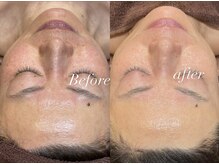 レシェルサロン(Lechelle Salon)/40代エイジングハーブピーリング