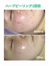 毛穴屋 京都/なめらか透明感肌へ。